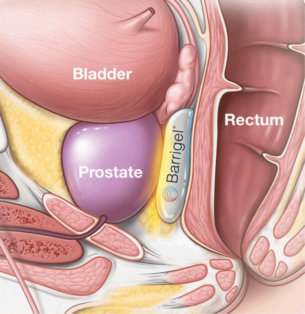 about-the-procedure-with-spacer